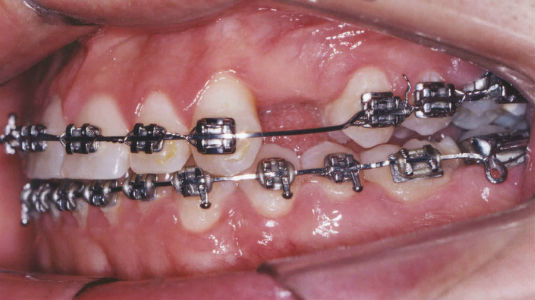 Patient's smile before dental implant placement