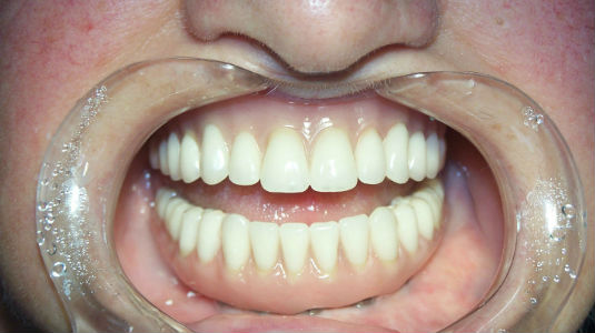 Patient's smile after full mouth restoration with dental implants