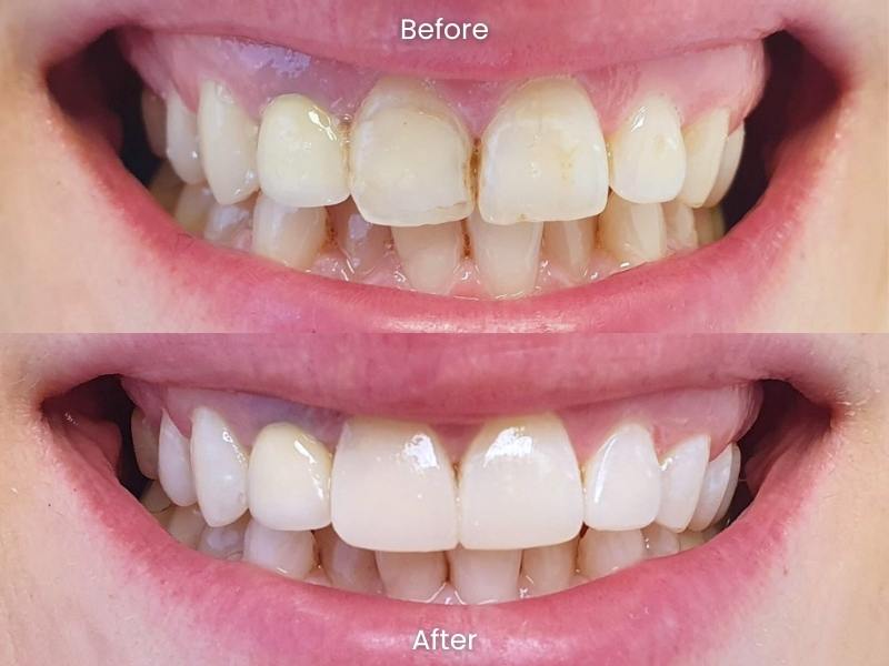 Composite bonding result