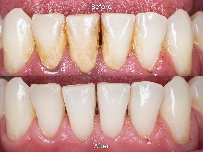 Dental hygiene treatment