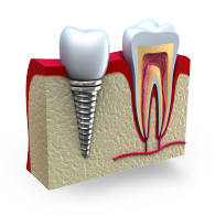 3D animated dental Implant next to a natural tooth
