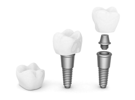 A dental crown, a dental implant and a dental implant split into 3 parts - crown, abutment and titanium screw. 