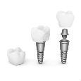 A dental crown, a dental implant and a dental implant split into 3 parts - crown, abutment and titanium screw. 