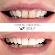 Composite bonding before & after