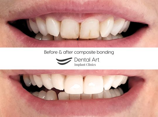 Composite bonding before & after