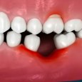 Consequences of a Missing Tooth