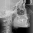 Dental Implant x-ray