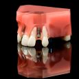 Turkey Dental Implants: Costs, Safety, and Alternatives for Londoners