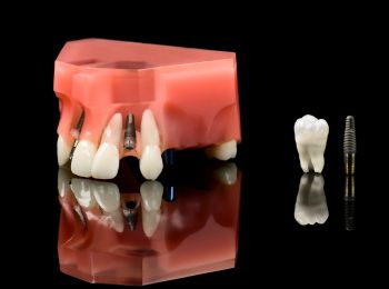 Turkey Dental Implants: Costs, Safety, and Alternatives for Londoners