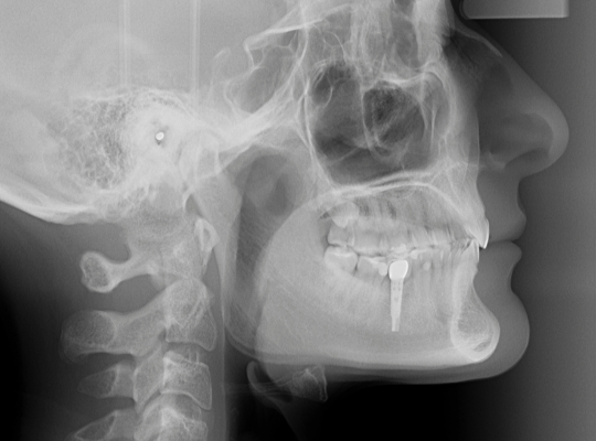 Dental Implant x-ray