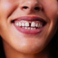 How to Reduce a Front Tooth Gap (Diastema)