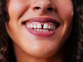 How to Reduce a Front Tooth Gap (Diastema)
