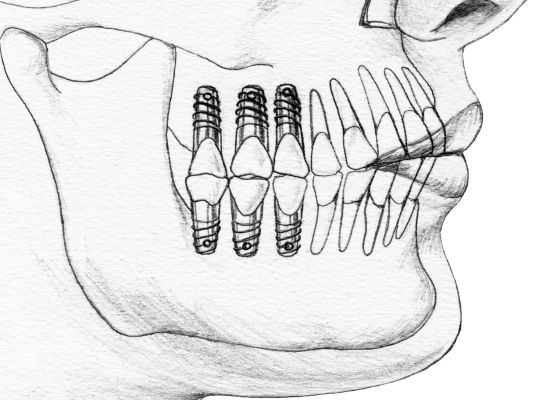 Illustration of dental implant placement – addressing patient concerns about pain during the procedure