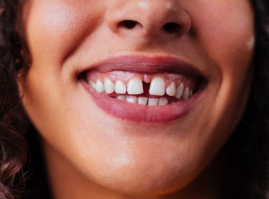 How to Reduce a Front Tooth Gap (Diastema)