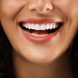 Porcelain Veneers visible for a smiling woman
