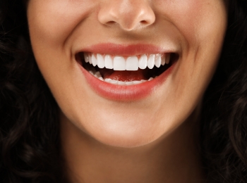 Porcelain Veneers visible for a smiling woman