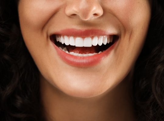 Porcelain Veneers visible for a smiling woman