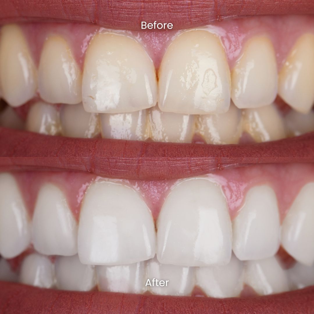 Teeth whitening