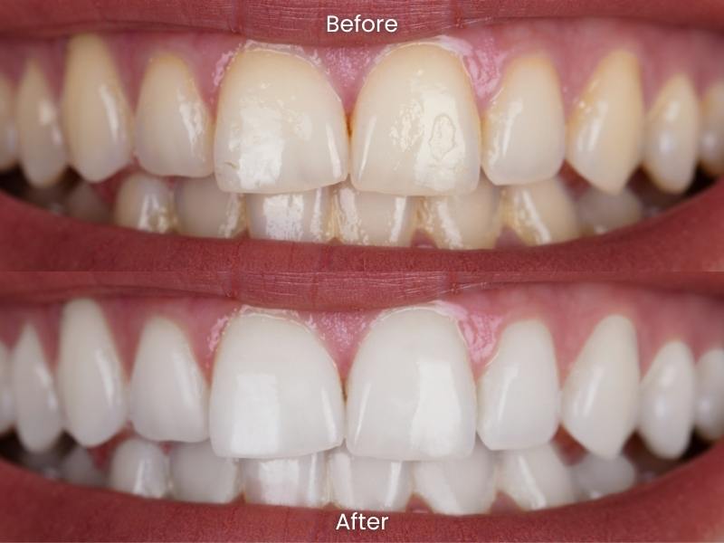 Teeth whitening at home