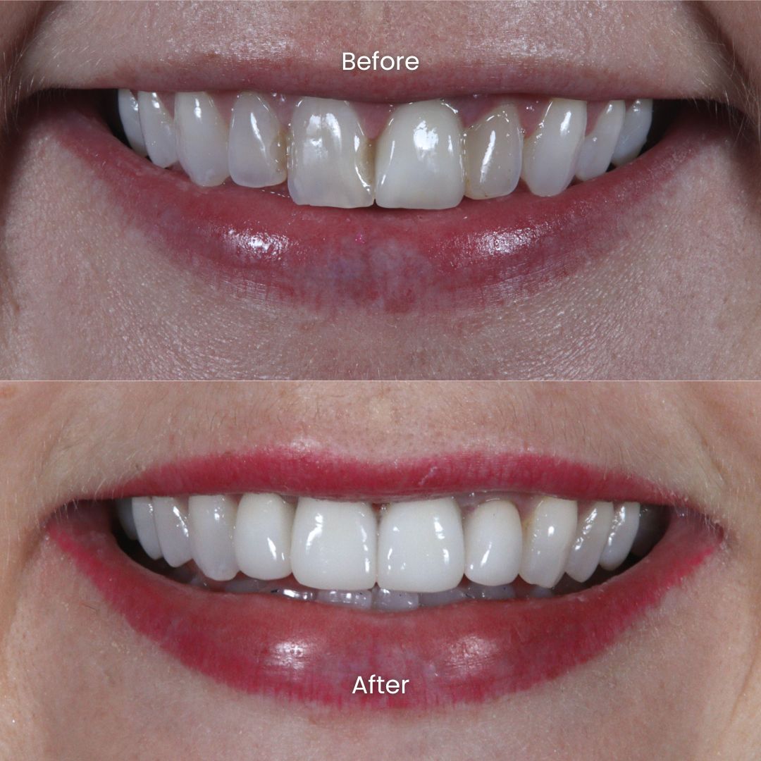 Porcelain Veneers