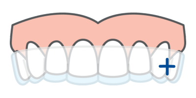 ordoline clear aligners basic