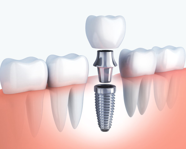 Dental Implant