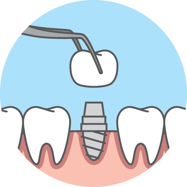 dental implant