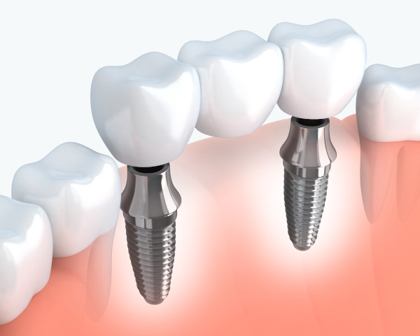 Dental Implant Supported Bridge