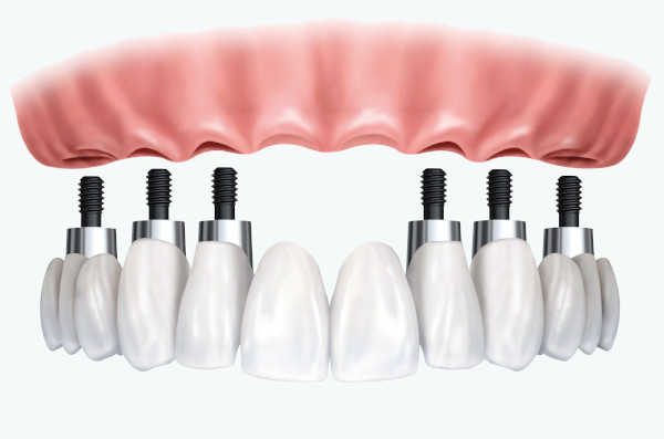 Full Mouth Restoration with Dental Implants