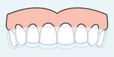 clear aligners