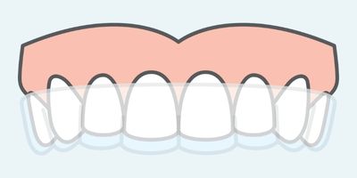 clear aligners