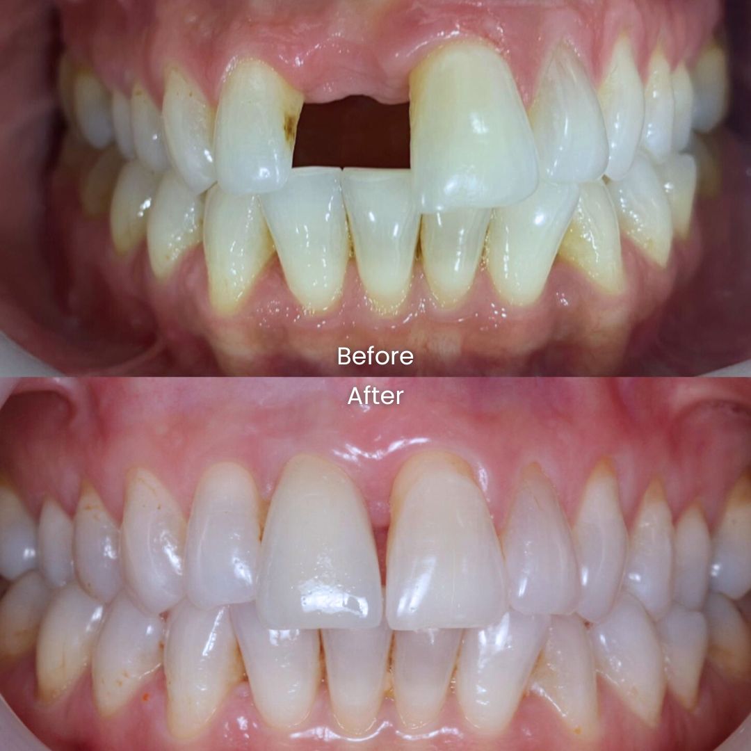 Dental Implant before and after