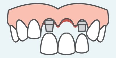 dental implant supported bridge