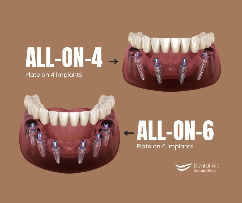 Image of all-on-4 and all-on-6 dental implants example