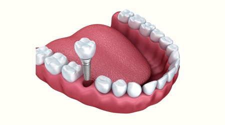 dental implant