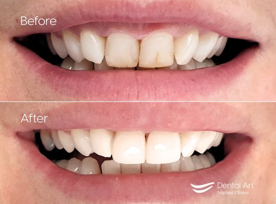 Before & After composite bonding