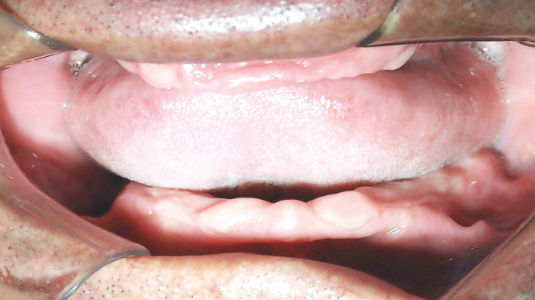 Patient's smile before full mouth restoration with dental implants