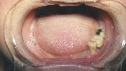 Patient's smile before full mouth restoration with dental implants