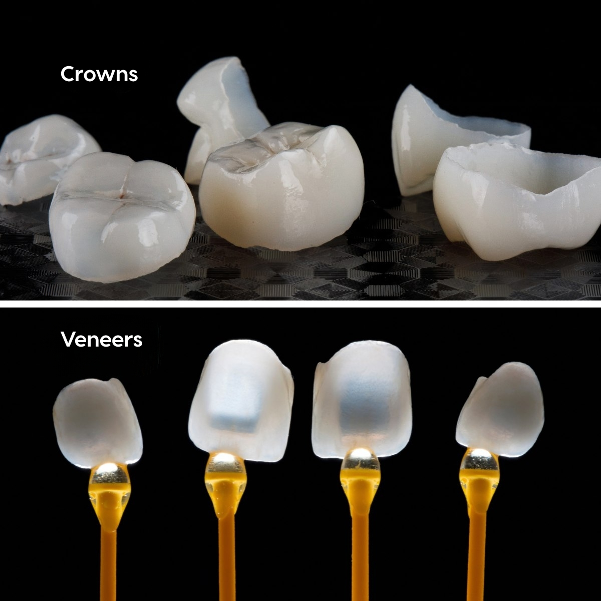 Crowns vs porcelain veneers