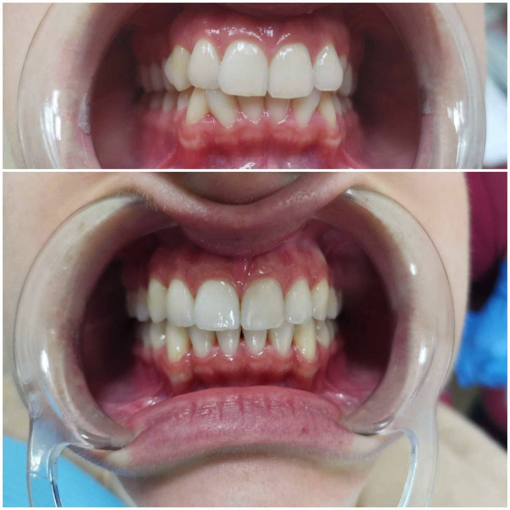 Clear Aligners - Before and After - Crooked Teeth
