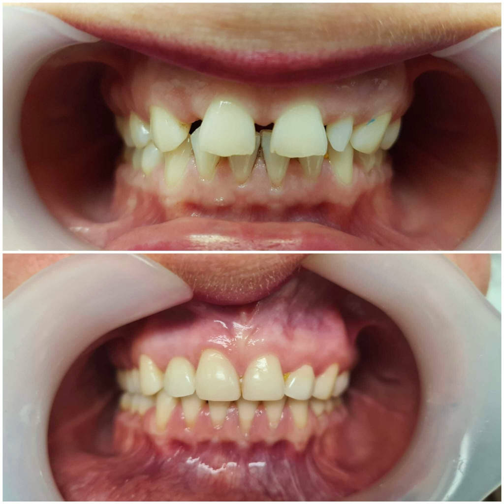 Clear Aligners - Before and After - Spacing and Gaps