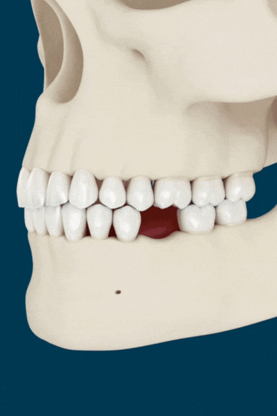 What happens after you loose a tooth - 3d example