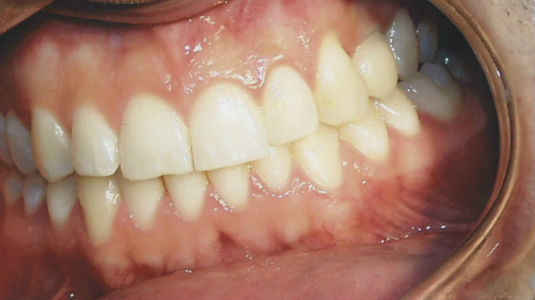 Patient's smile after dental implant placement