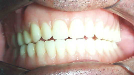 Patient's smile after full mouth restoration with dental implants