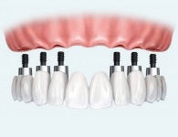 Full Mouth Restoration denture on 6 dental implants