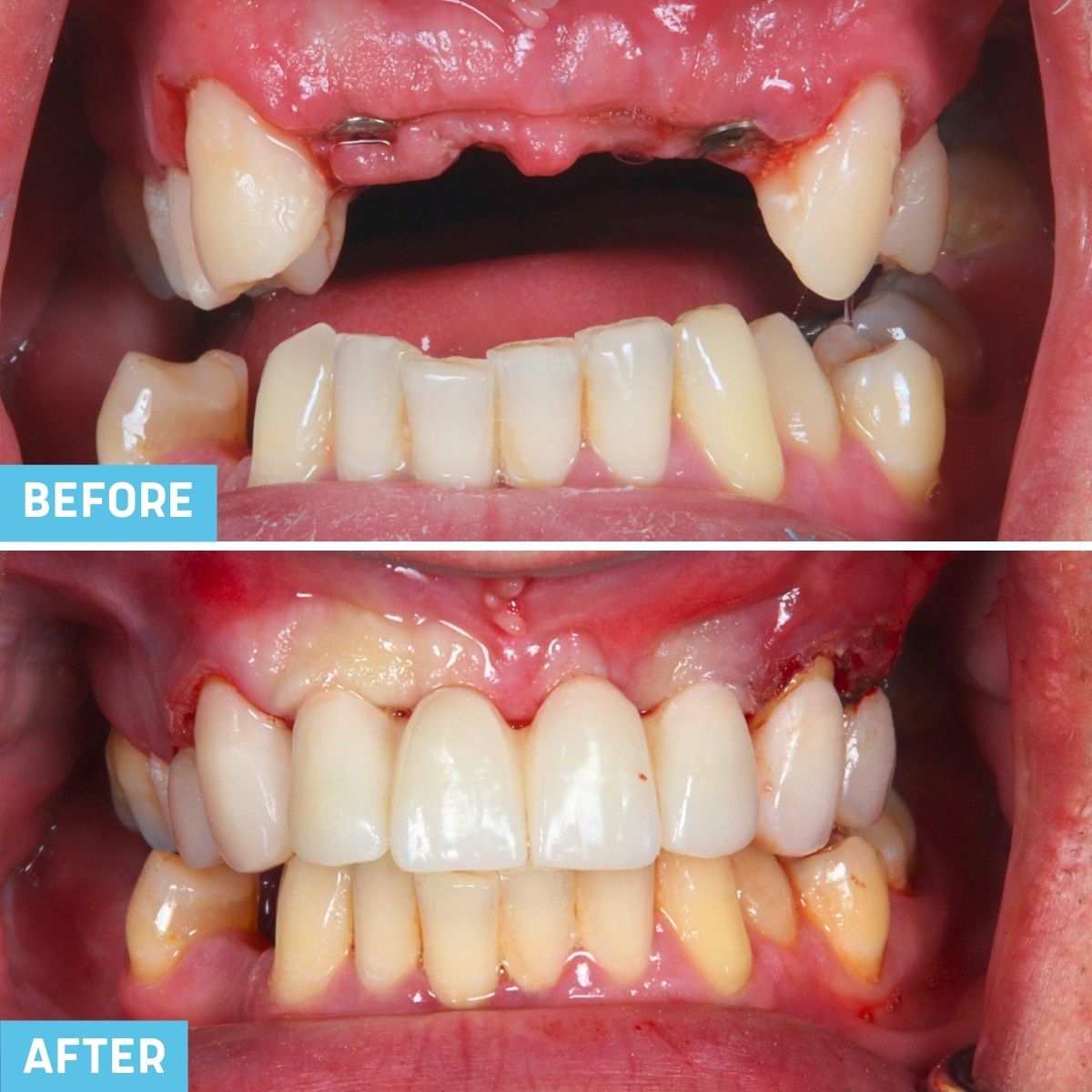 dental implant supported bridge - before and after