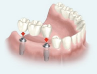Dental implant bridge placement