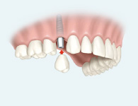Dental implant bridge inside the mouth