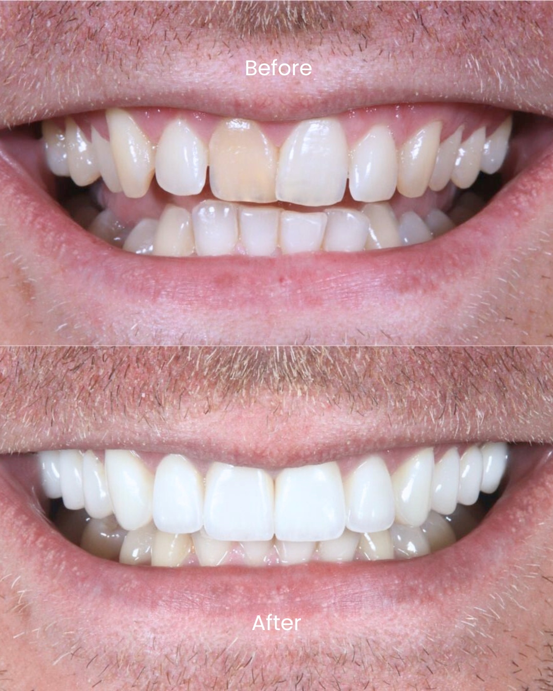 Porcelain veneers before and after