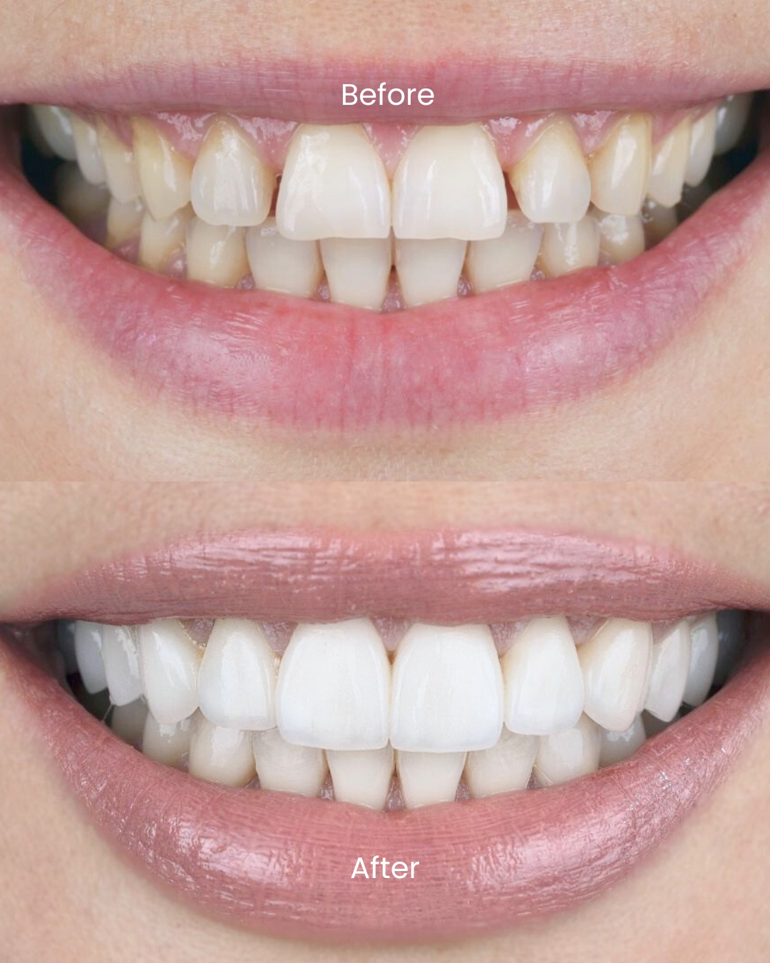 Porcelain veneers before and after